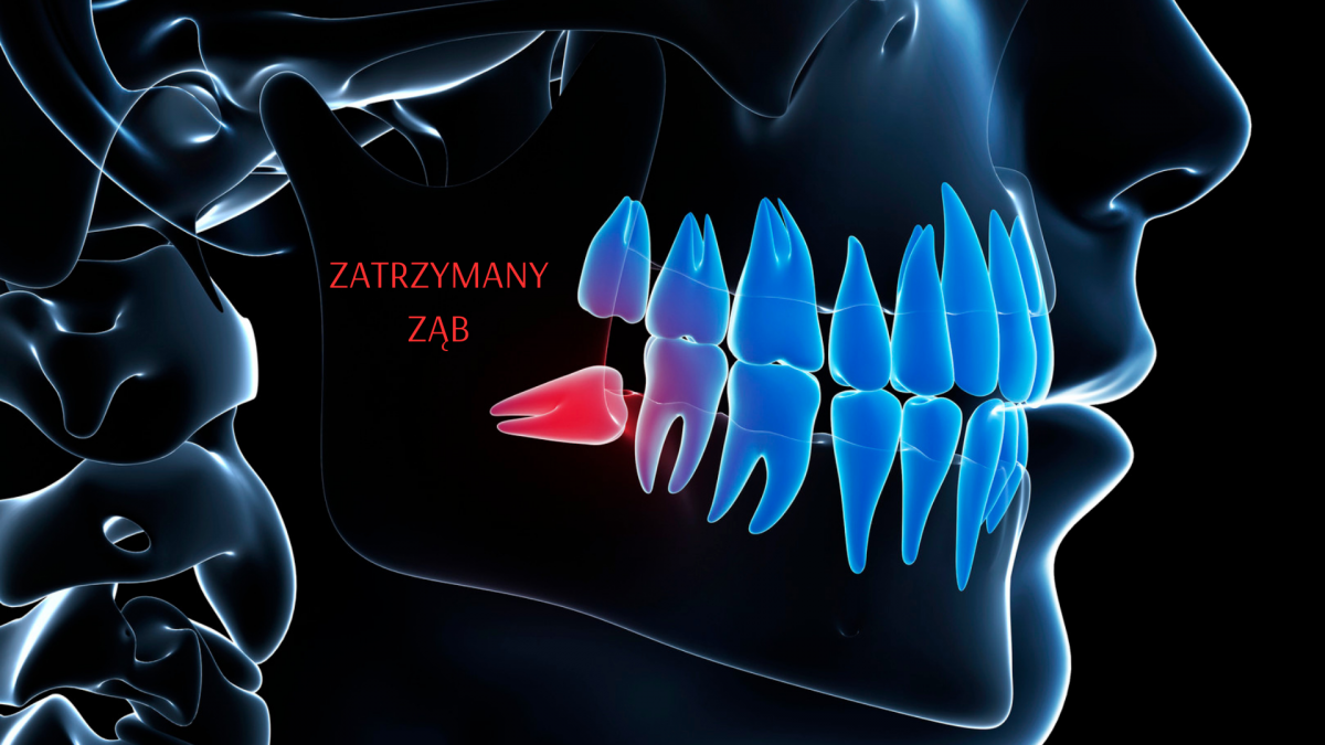  Jak leczyć zatrzymany ząb? Kraków i okolice 